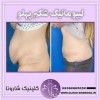 پروتز سینه و لیپوماتیک در نارمک