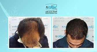 کاشت مو در ایران نوین دو و نیم میلیون تومان