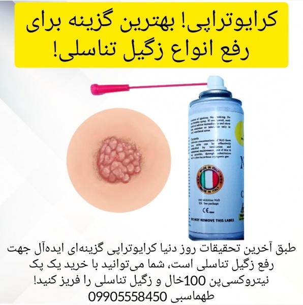 فروش اسپری کرایوتراپی نیتروکسی درمان زگیل تناسلی