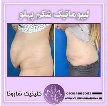 پروتز سینه و لیپوماتیک در نارمک